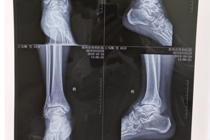 腳踝腳底板周?chē)弁词鞘裁丛?>
                  </p>
              </a>
    </li>
                  <li>
      <a href=