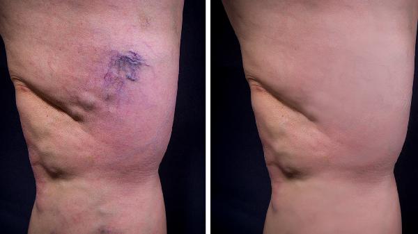 如何讓大象腿變筷子腿的方法