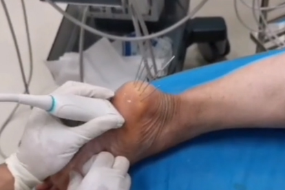 足底筋膜炎掛骨科還是疼痛科