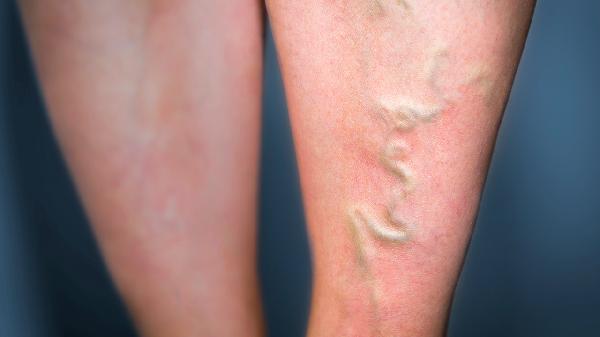 上眼皮起個(gè)疙瘩還浮腫怎么辦