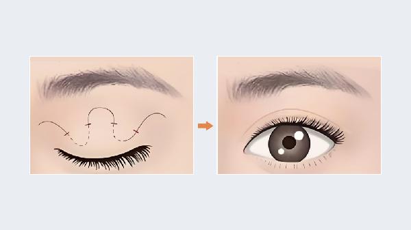 雙眼皮修復手術(shù)什么時(shí)候做好