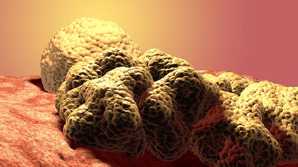 海蜇是癌細胞最喜歡吃的嗎