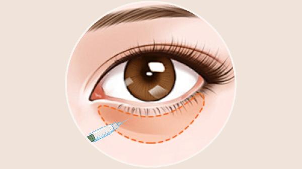 做自體真皮豐臥蠶價格是多少