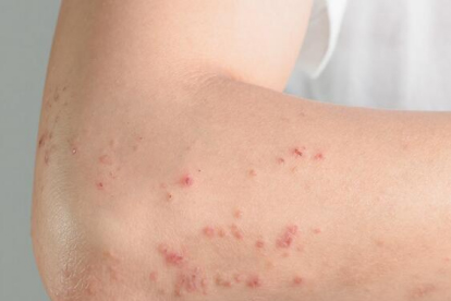 小寶寶長(zhǎng)濕疹怎么辦