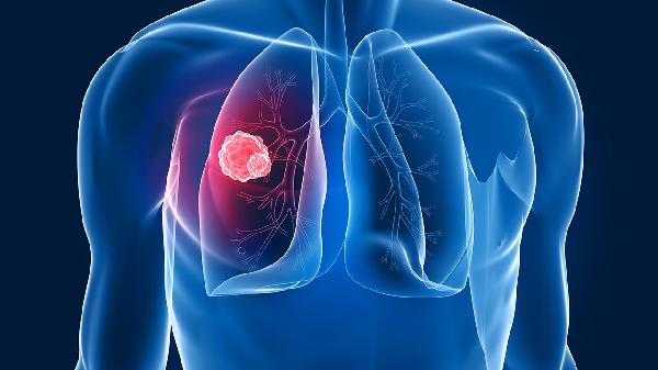 如何檢查肺部疾病