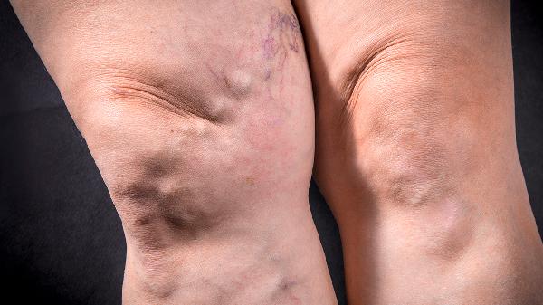 痛風(fēng)疾病需要遠離什么食物