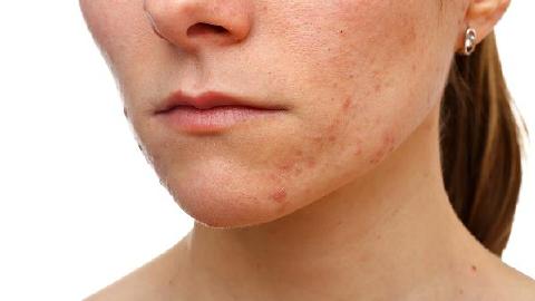 透明質(zhì)酸隆下巴有殘留物嗎