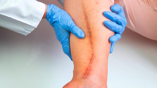 疤痕修復術(shù)方法大PK