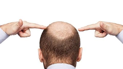 遺傳性脫發(fā)如何治療效果好