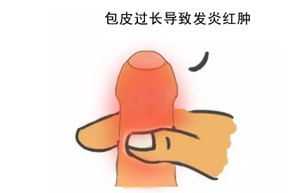 小男孩包皮過長(zhǎng)需要做手術(shù)嗎