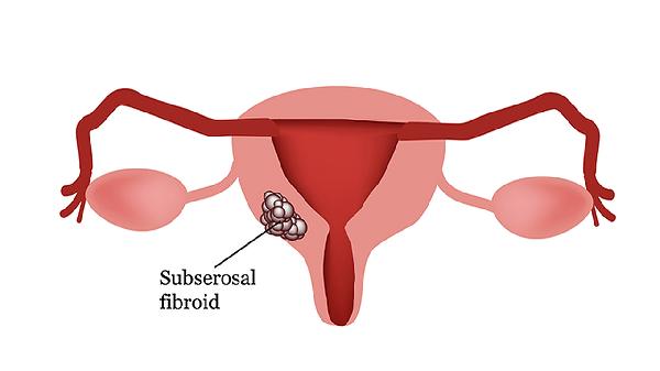 宮頸腺癌是什么一回事