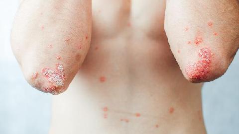 常見的牛皮癬是什么樣的