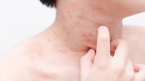 蕁麻疹能治好嗎