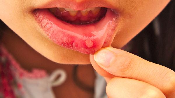 口腔潰瘍的表現(xiàn)是什么