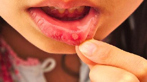 口腔溃疡的表现是什么