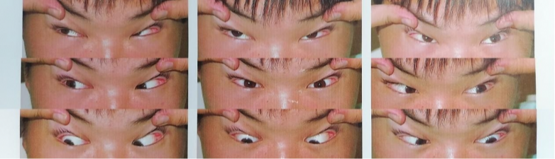 不戴鏡+沉迷手機(jī)誘發(fā)斜視 南昌愛爾楊秋艷手術(shù)助其重獲清晰視界