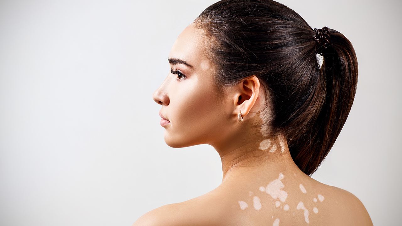 治療早期白癜風(fēng)應(yīng)注意這些事項 早期白癜風(fēng)應(yīng)怎么治療好