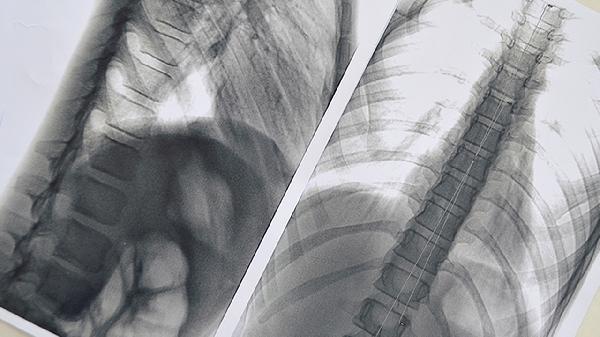 右肺下葉切除術(shù)的恢復(fù)期是多長
