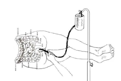 灌腸的好處和壞處