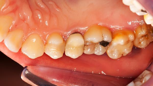 五個壞習(xí)慣破壞了牙齒的健康