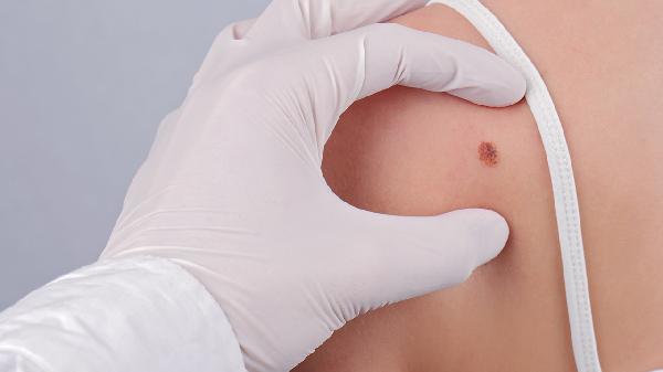 激光去黑色素痣的優(yōu)點(diǎn)