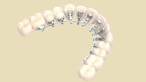 牙齿矫正观念上的七大误区