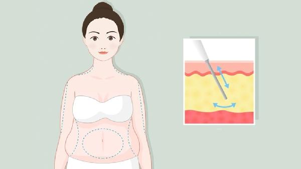 共振吸脂多少錢