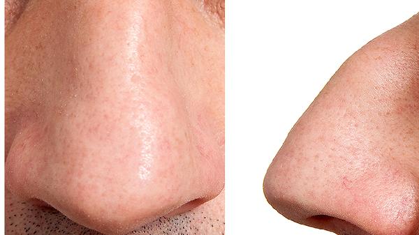 驼峰鼻矫正的两种整形方案