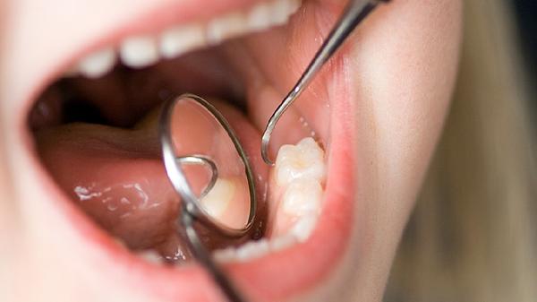 牙結石洗牙要多少錢(qián)