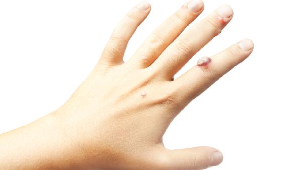 女士濕銳疣一般長(zhǎng)在哪里