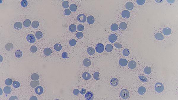 阿基仑赛注射治疗什么癌症