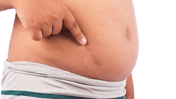 疤痕增生手術(shù)要花多少錢(qián)