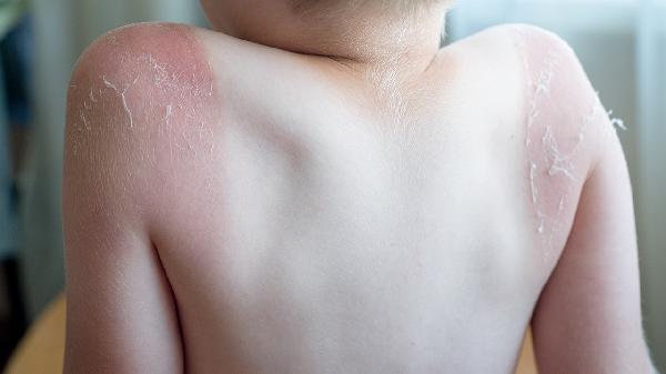 煙頭燙傷起了水泡該怎么辦