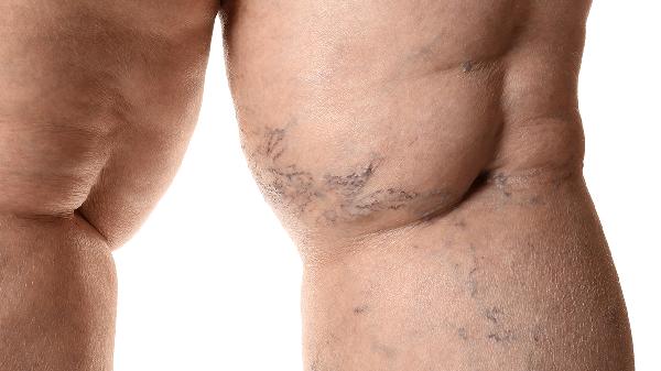 小腿浮腫臉浮腫是什么原因