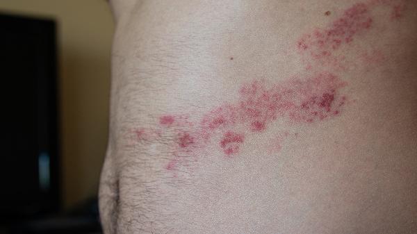 點(diǎn)狀牛皮皮癬怎么治