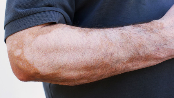 白癜風(fēng)常見(jiàn)癥狀有哪些啊