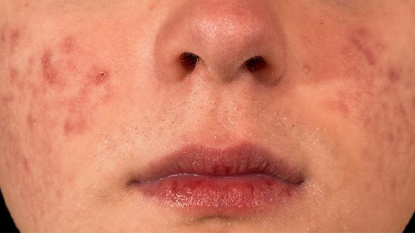 怎么改善皮膚毛孔粗大