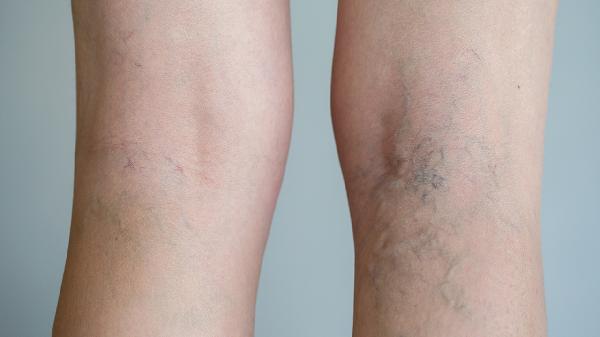 怎么緩解手部靜脈曲張