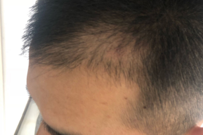 脂溢性脫發(fā)頭癢怎么辦