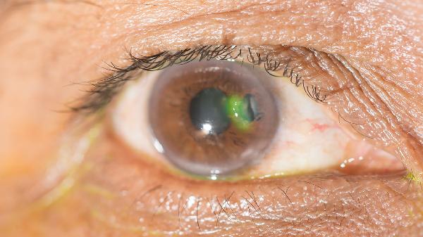 白内障手术的禁忌症