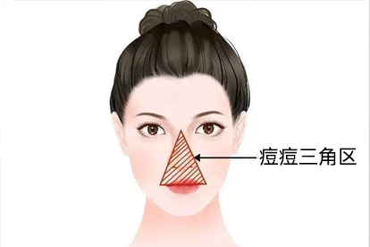 痘痘肌是什么肌質(zhì)啊