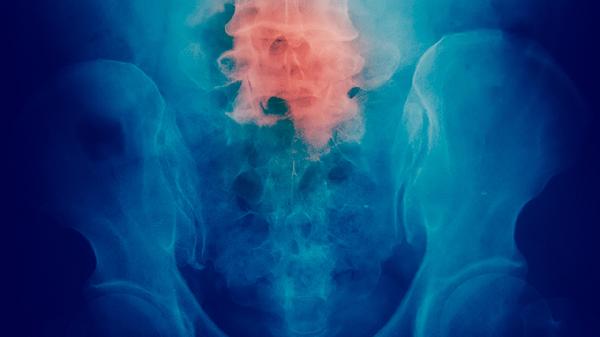 肺癌有什么臨床表現(xiàn)