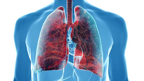 肺部纖維灶怎么回事