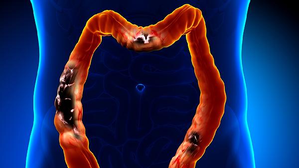 腹瀉一年多是腸癌嗎