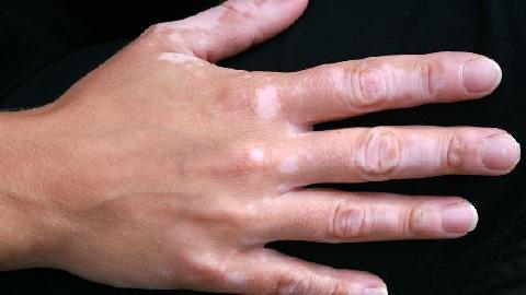 孩子胳膊上有白斑点