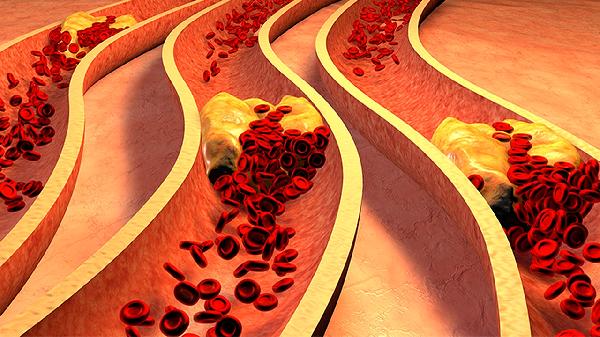 脊髓血管病怎么治療
