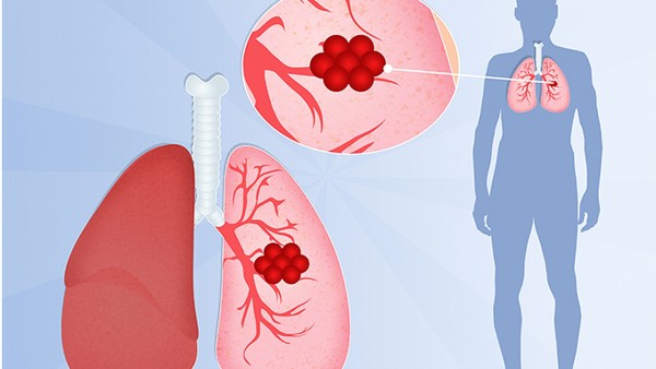肺结核空洞为什么2年后还咳血
