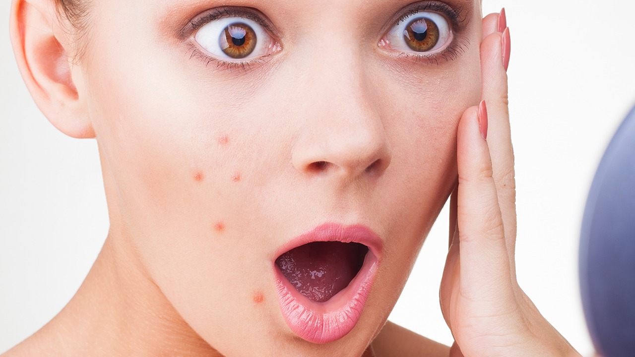 如何擺脫痤瘡的煩惱？提醒：改掉這4個(gè)“壞毛病”，助你緩解