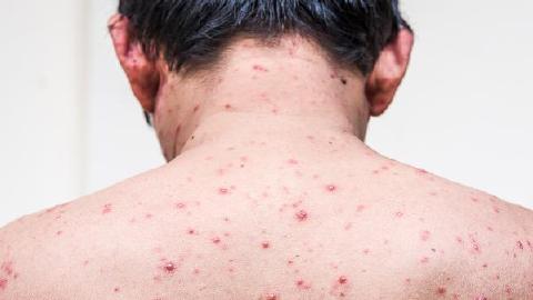 维德思可不可以用于治疗生殖器疱疹复发
