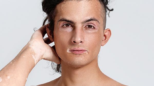 白癜風(fēng)患者日常應(yīng)該注意什么